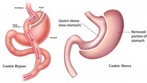 Gastric Bypass Vs. Gastric Sleeve Weight Loss Surgery