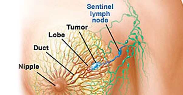 sentinel lymph node