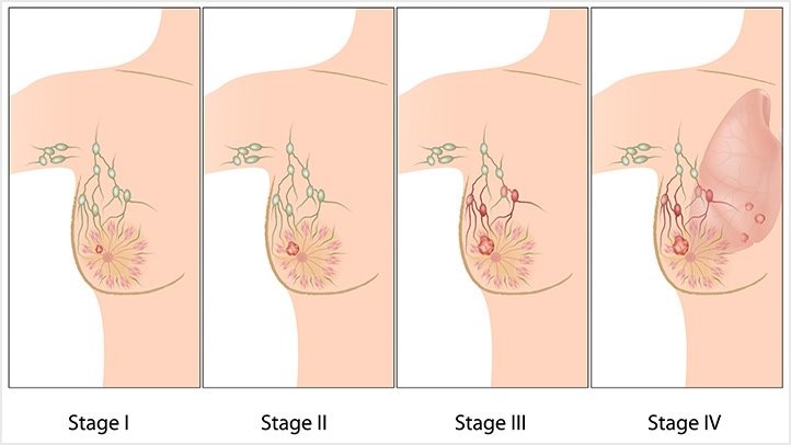 stages of breast cancer