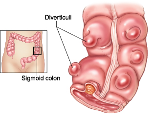 IMG 2795 - Diverticulitis of the COLON